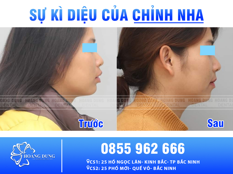 Chỉnh nha tước sau 2