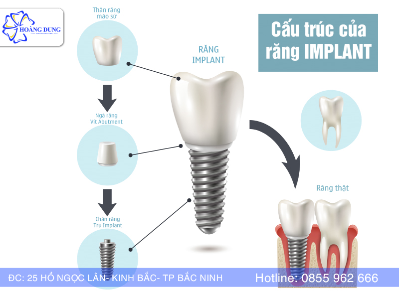 Cấu trúc Implant