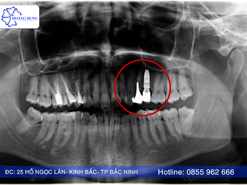 Hình ảnh răng implant khi hoàn thành