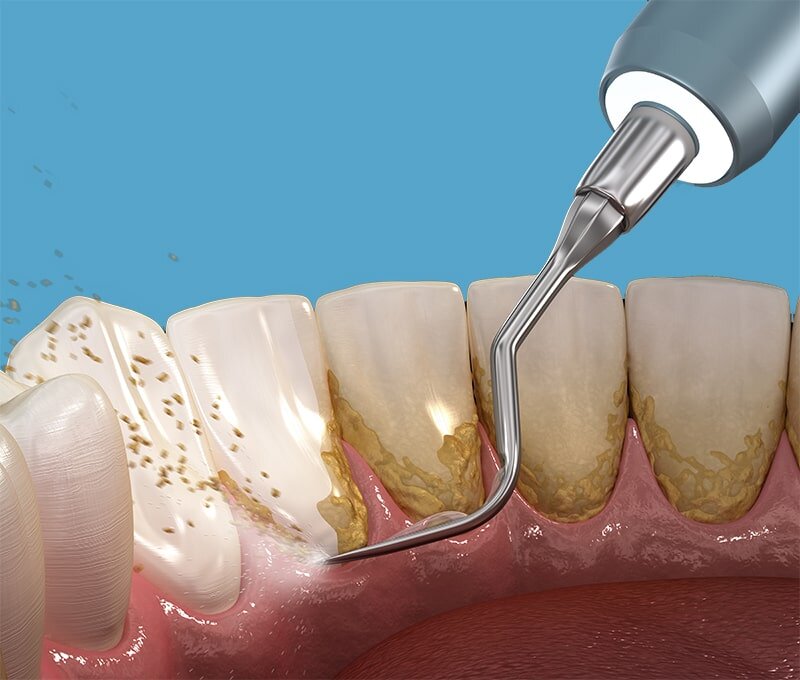 Không đánh răng thường xuyên sau khi ăn và trước khi đi ngủ