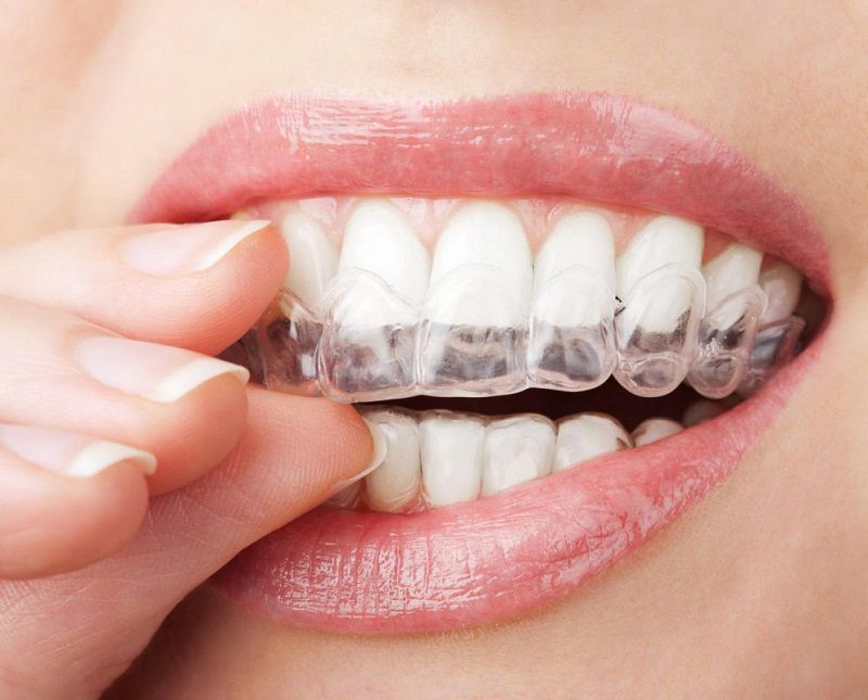 Niềng răng Invisalign là gì