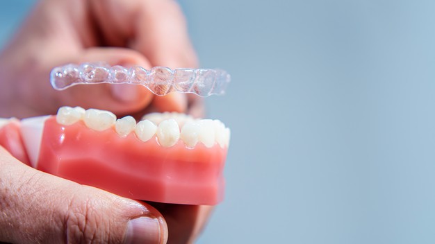 Niềng răng khấp khểnh bằng cách sử dụng khay niềng trong suốt Invisalign