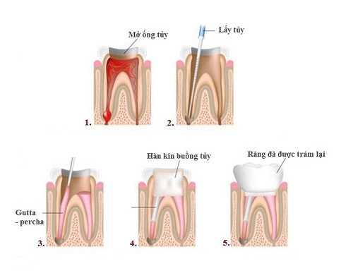 Quy trình kỹ thuật điều trị tủy răng