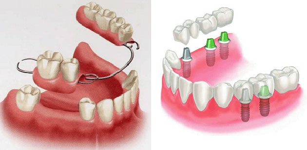 So sánh hàm tháo lắp và implant