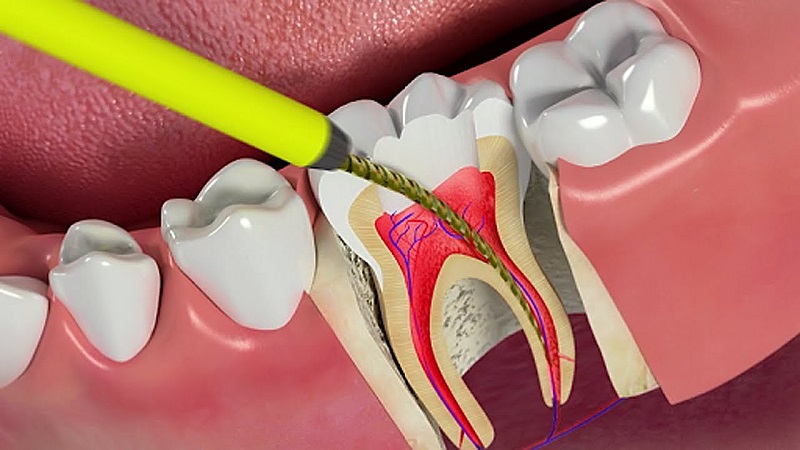 chữa tủy răng có ảnh hưởng đễn răng vĩnh viễn k