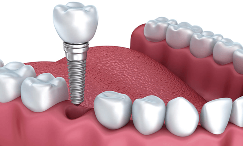 làm implant ở đâu tốt