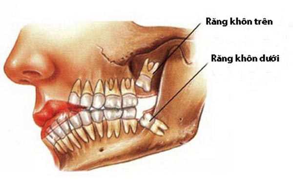 nha khoa nhổ răng khôn