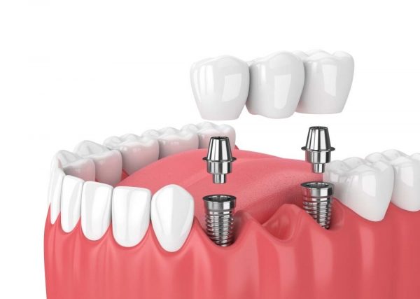 nha khoa trồng răng implant tiên tiến