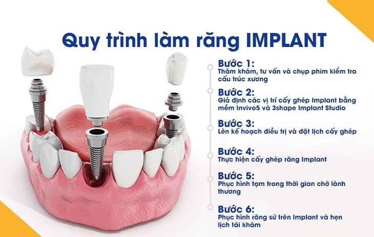 quy-trinh-trong-rang-Implant-mang-lai-hieu-qua-the-nao