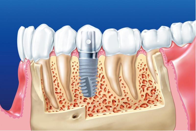 trong-rang-implant