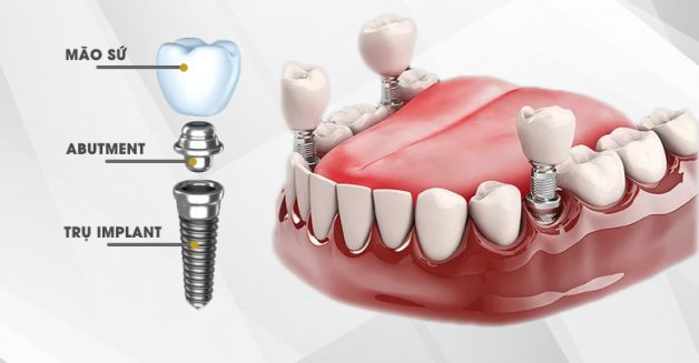 trong-rang-implant ở đâu uy tín