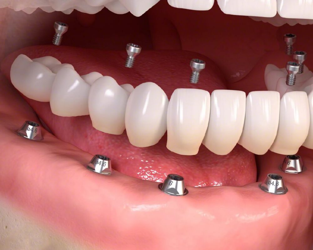 trồng răng implant bao lâu