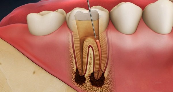 Đau tủy răng phải làm sao để điều trị