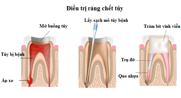 điều trị tủy đúng cách