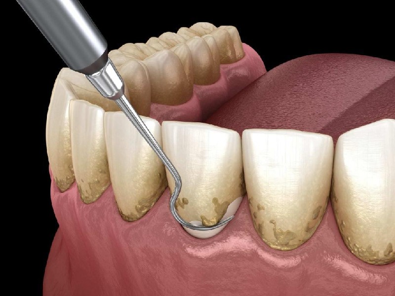 điều trị viêm nha chu ở đâu