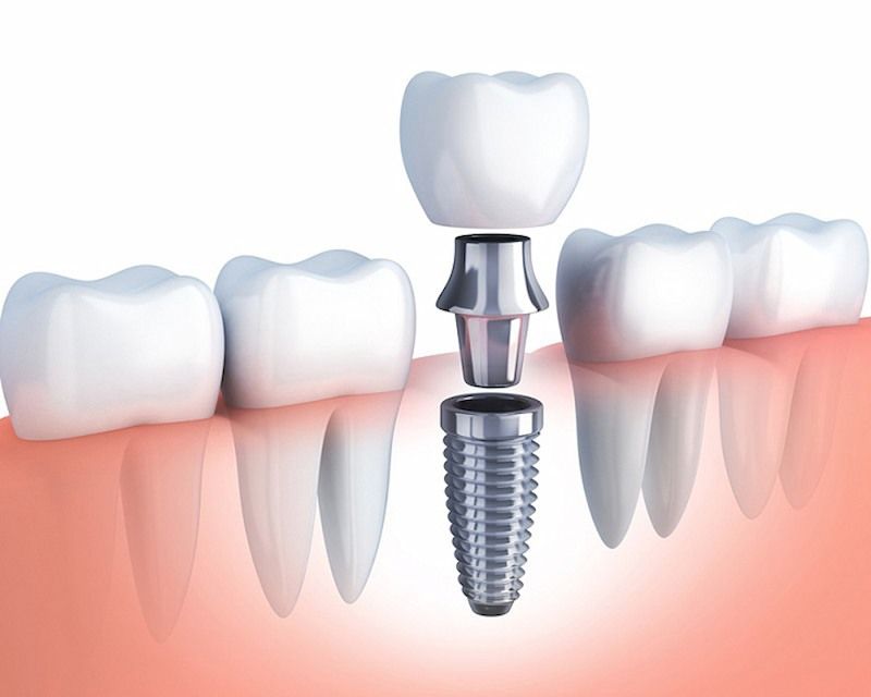 Giải đáp chi phí trồng implant bao nhiêu