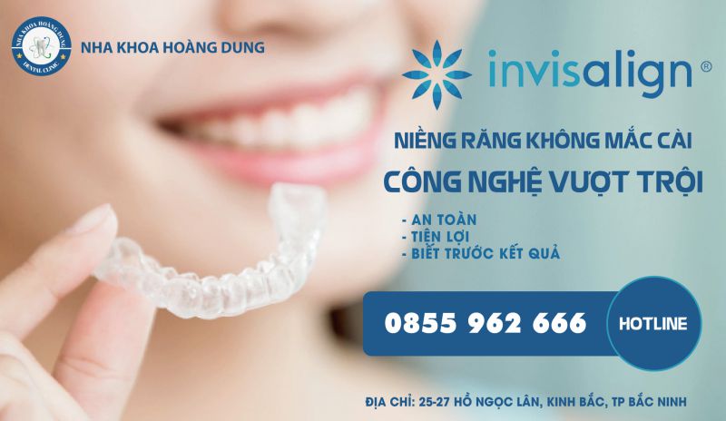 Niềng răng bằng máng Invisalign