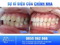 Tất tần tật những thông tin quan trọng cần biết trước khi niềng răng hô