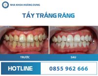 TẨY TRẮNG RĂNG