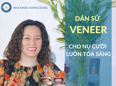 CHỊ CHUNG DÁN SỨ VENEER