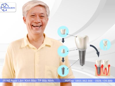 Trồng răng implant - Phương pháp trồng răng hiện đại, an toàn, không đau