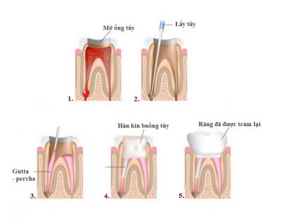 Quy trình điều trị tủy răng đúng cách, tiết kiệm thời gian và chi phí