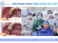 Quy trình cắm implant hiện đại tại Nha Khoa Hoàng Dung