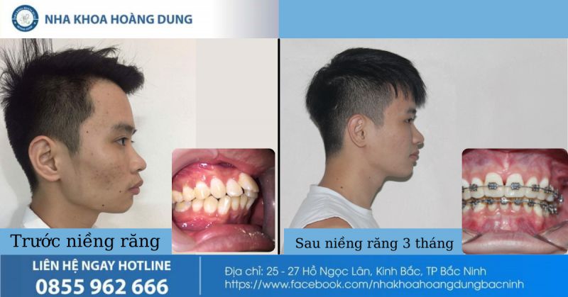 Thay Đổi Sau 3 tháng niềng răng