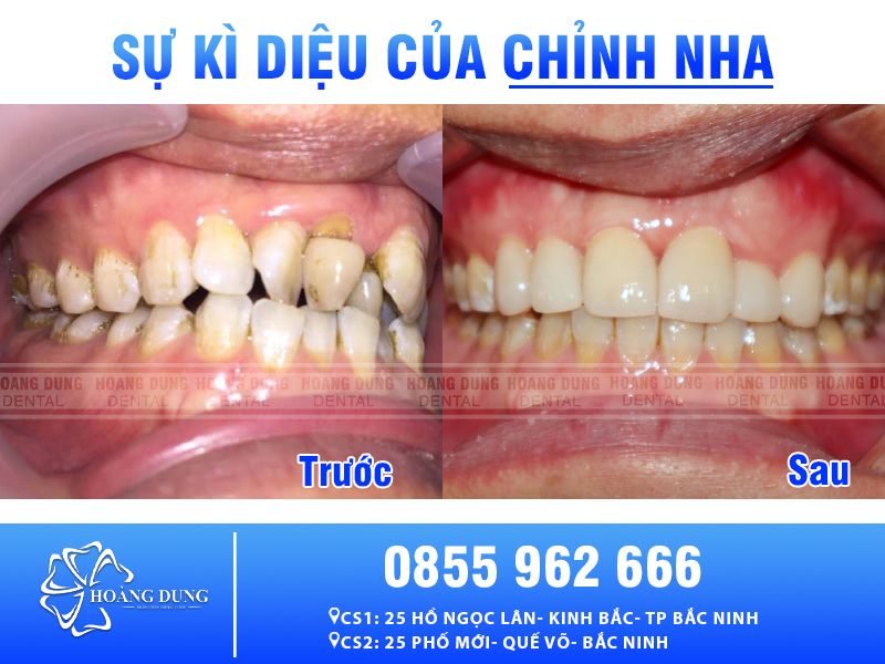 Tìm hiểu về phương pháp niềng răng khấp khểnh cho nụ cười đẹp như mơ