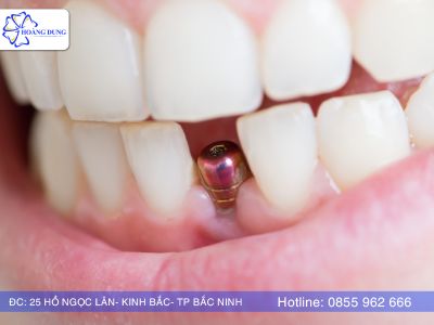 Giải đáp băn khoăn của mọi người về trồng Implant có đau không?