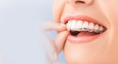 NIỀNG RĂNG INVISALIGN