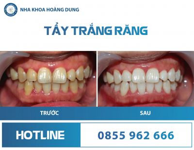 TẨY TRẮNG RĂNG