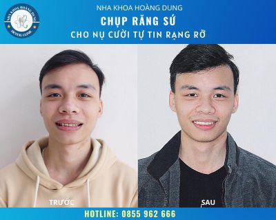 TUẤN ANH TRƯỚC VÀ SAU KHI LÀM THẨM MỸ