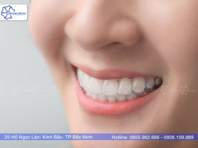 Niềng răng Invisalign là gì? Có nên lựa chọn phương pháp niềng răng này hay không?