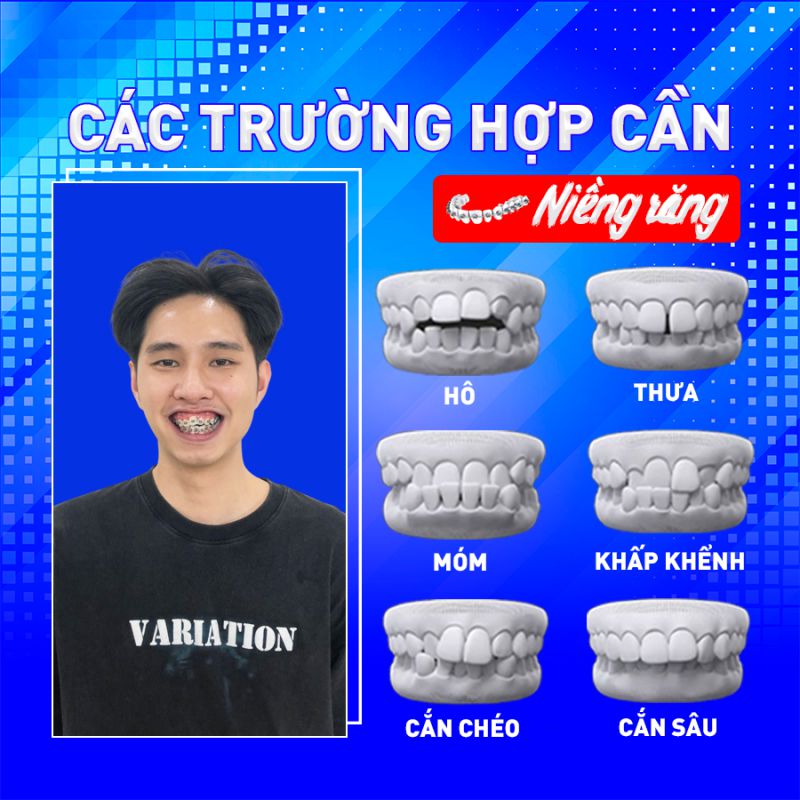 CÁC TRƯỜNG HỢP LÊN NIỀNG RĂNG