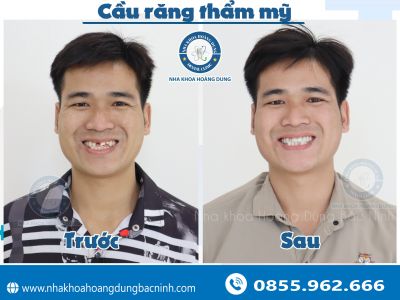 TÙNG ANH SAU KHI LÀM CẦU RĂNG THẨM MỸ