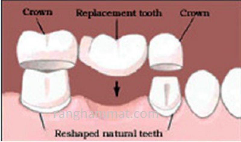 Chụp răng giả là gì ?